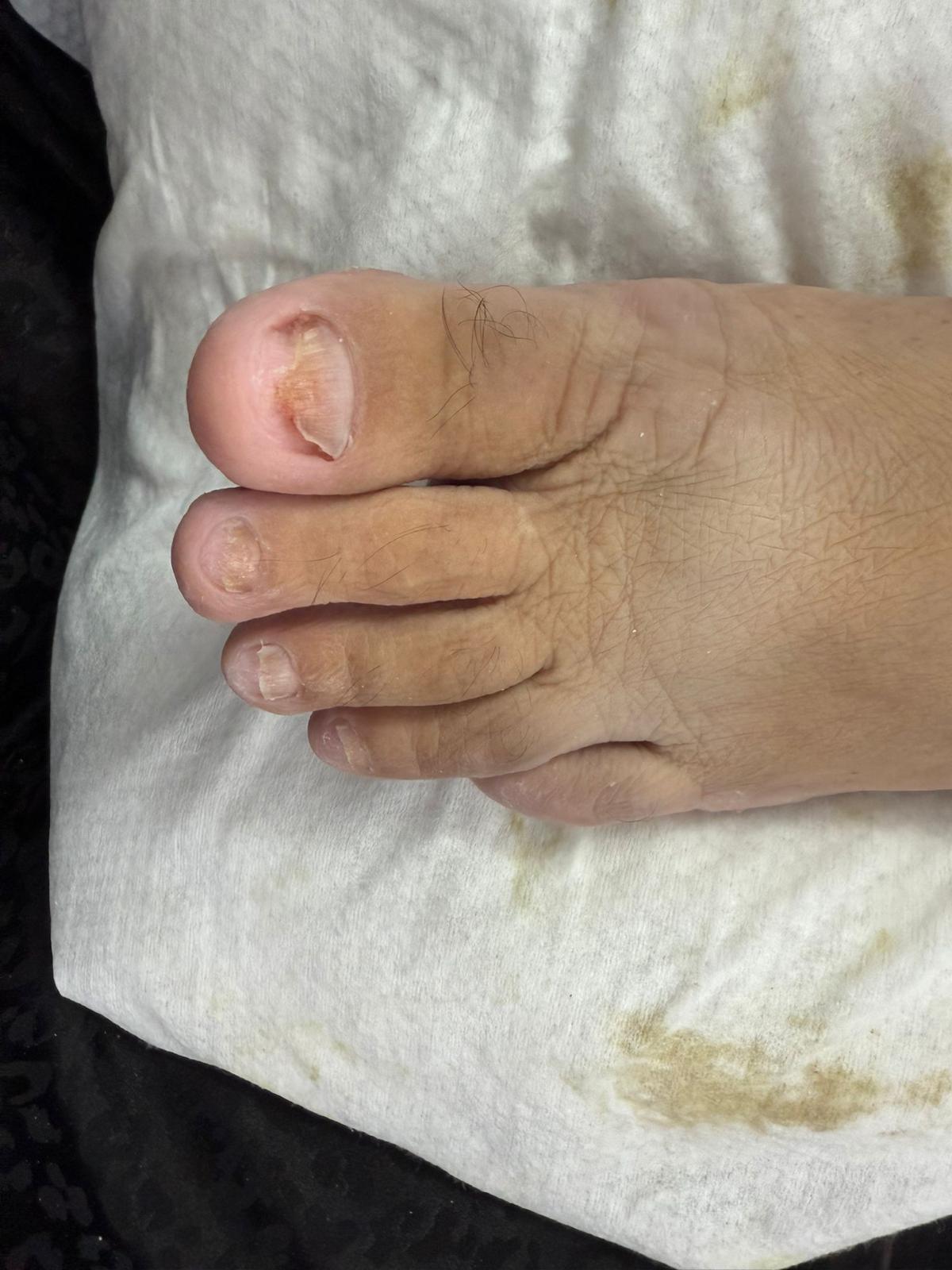 פדיקור רפואי לפני ואחרי